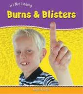 It's Not Catching: Burns And Blisters Hardback