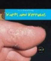It's Catching: Warts and Verrucas Hardback